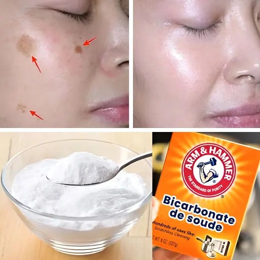 4 facons deffacer les taches de vieillesse avec du bicarbonate de soude pour une peau plus jeune et plus uniforme 1.jpg