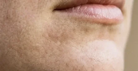 Les poils au menton dune femme sont un signe de.jpg