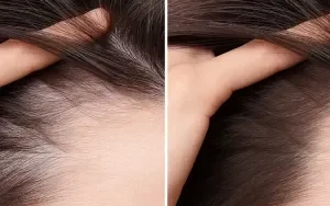 Chute cheveux