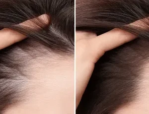Chute cheveux